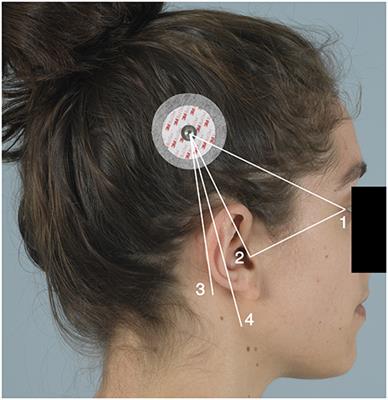 Cochlear Implant Receiver Location and Migration: Experimental Validation Pilot Study of a Clinically Applicable Screening Method